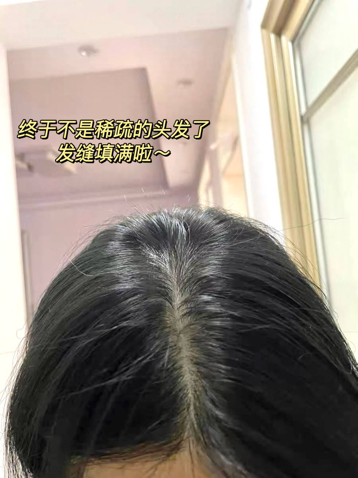 产后宝妈恢复发量，这育发精华强推！0刺激0狂脱