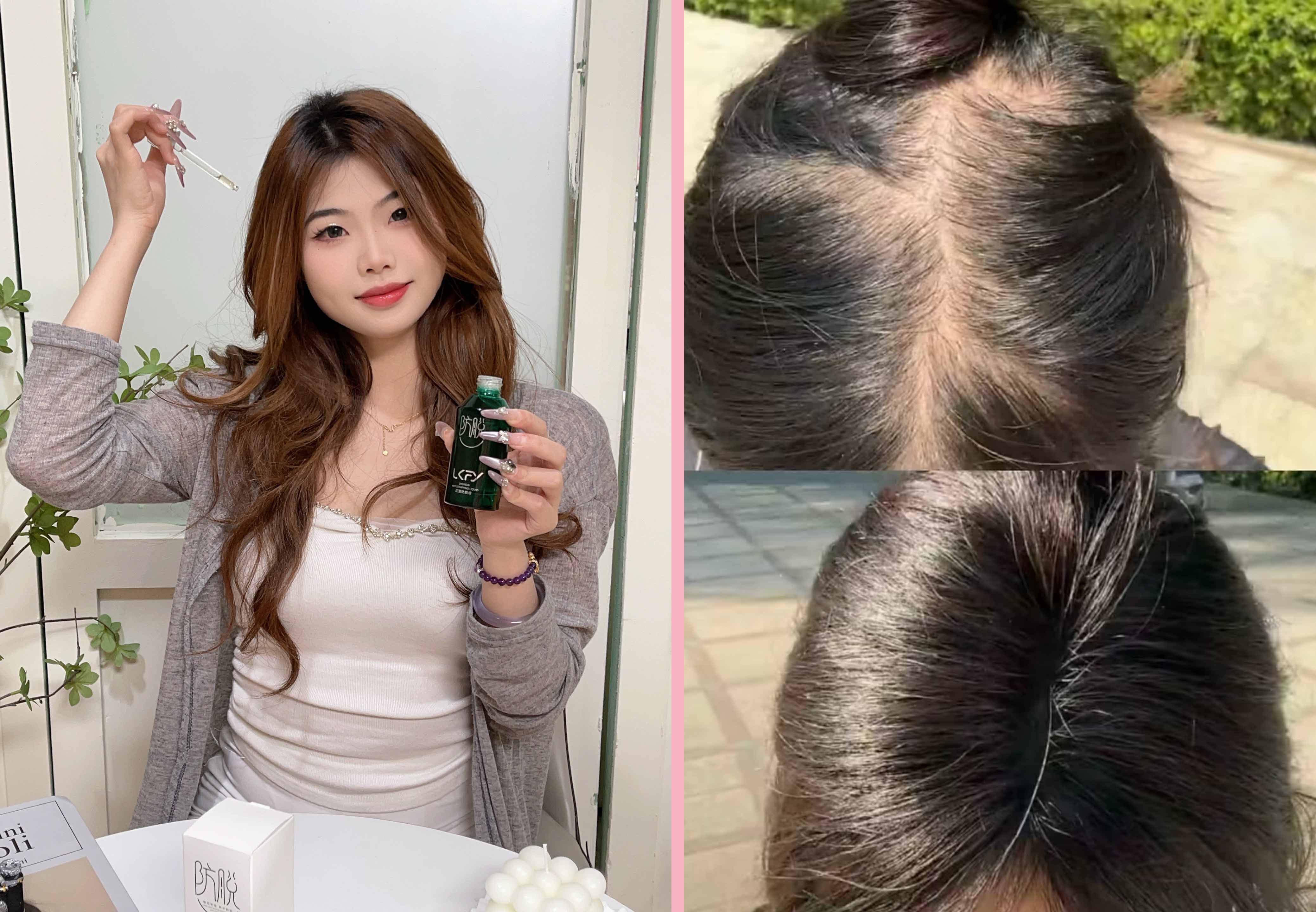 世界公认有效防脱生发排名，TOP育发液横测，直降50％脱发量