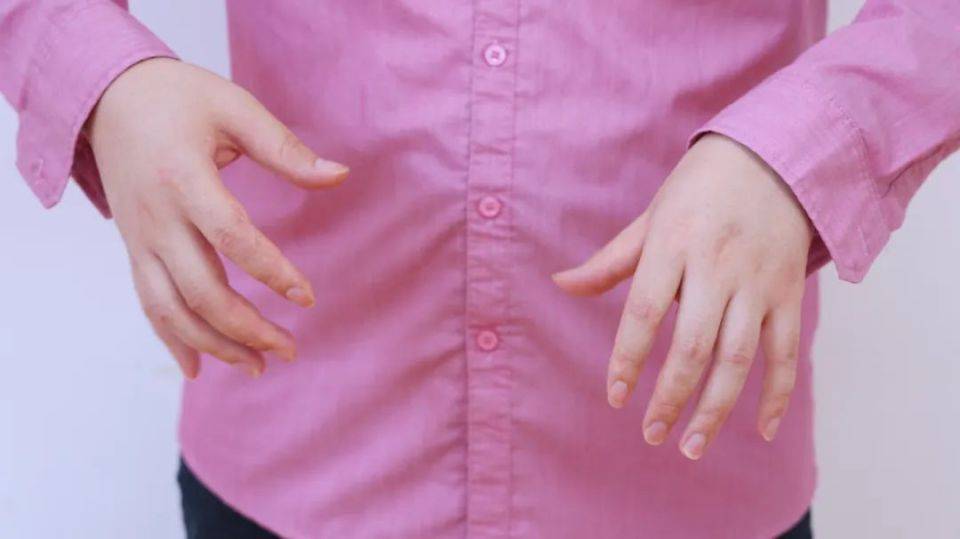 痛风患者若是病情加重，身体会有哪些表现？