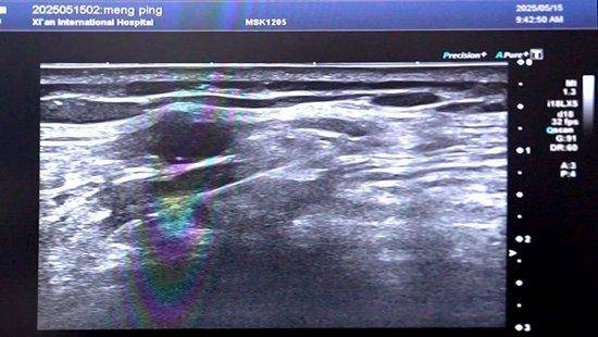 止痛药+止痛泵失效后的第700天 医生用一根针改写结局