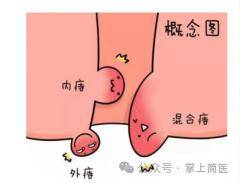 健康科普 | 不容忽视的“难言之隐”——深度解析混合痔的危害与健康警示
