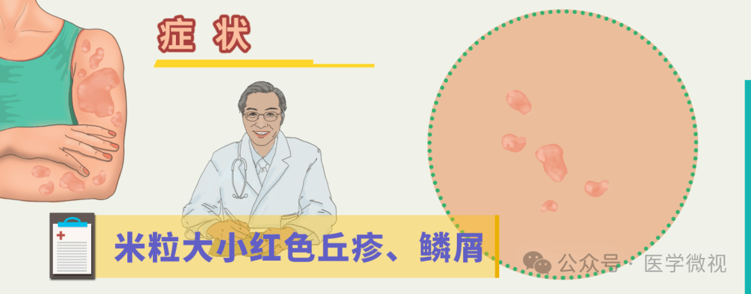 银屑病（牛皮癣）冬重夏轻？夏季也要做好皮肤护理！