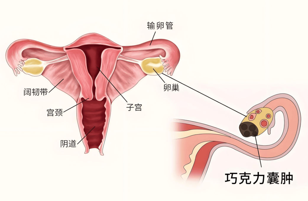 巧克力囊肿姐妹必看：是保守治疗？手术？还是怀孕？你该如何选择？