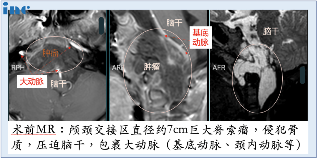 儿童脊索瘤一定要开颅手术吗？福教授“筷子技术”带来新可能！