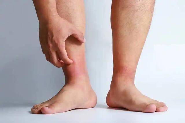 提醒：肠癌发出的第一个信号，通常在腿上，可惜很多人都没放心上