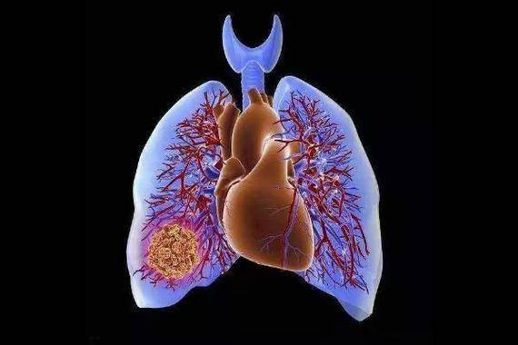 63岁老人因肺栓塞去世，医生劝告：3种行为要避免，有效保健康