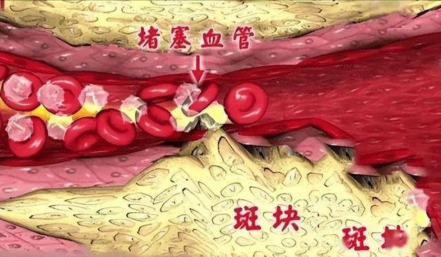 62岁大爷血管斑块多，是缺了叶酸?提醒：常吃4样，血液干净防血栓