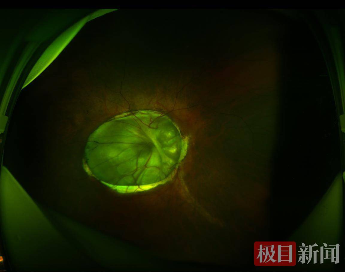 女子眼底开出一朵“牵牛花”！专家：眼球震颤、视力差，当心这种可致盲的罕见眼病