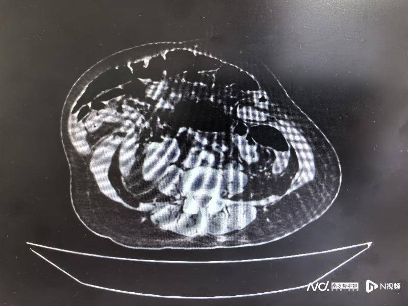 七旬老人胃肠“越狱”腹壁撕开31厘米 医生妙手修补成功