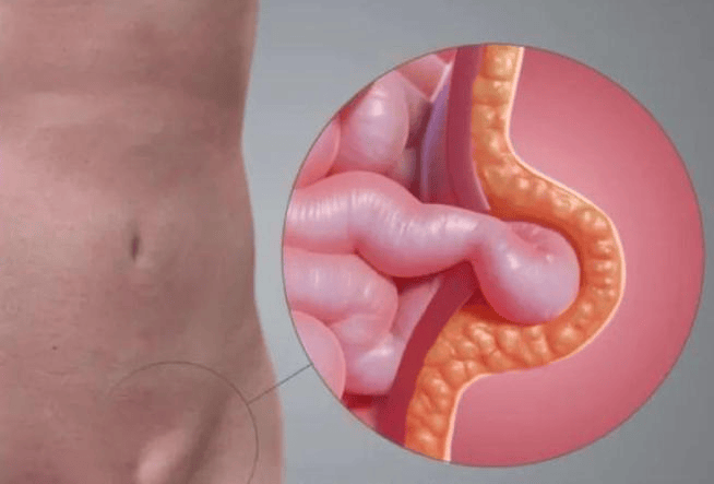 成人腹股沟疝：男性发病率高于女性