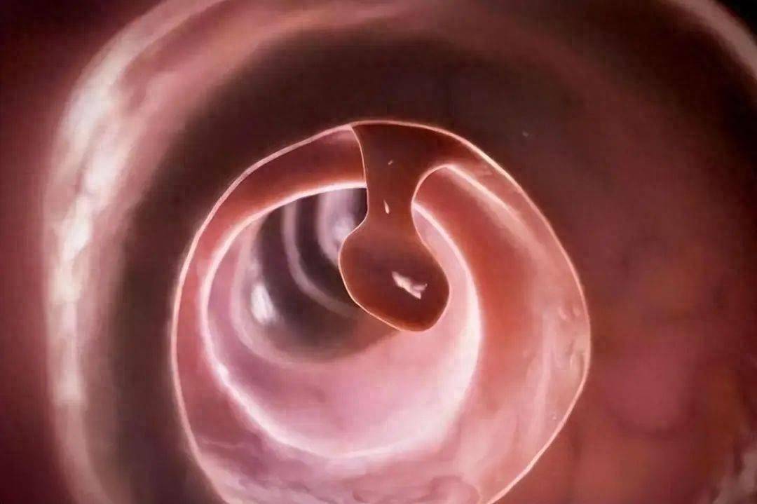 原创            90%以上结直肠癌源于肠息肉，但早切除息肉，能有效阻断癌症发生