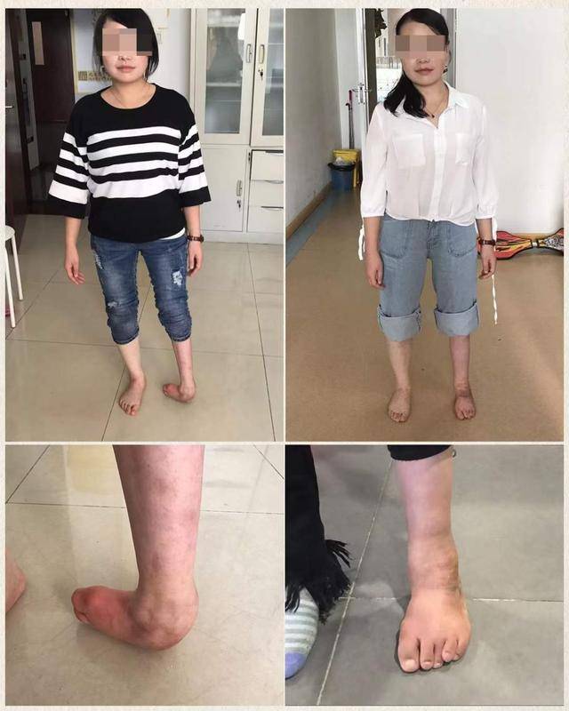 胡霞足踝无创矫形：让“不可能”成为“可能”