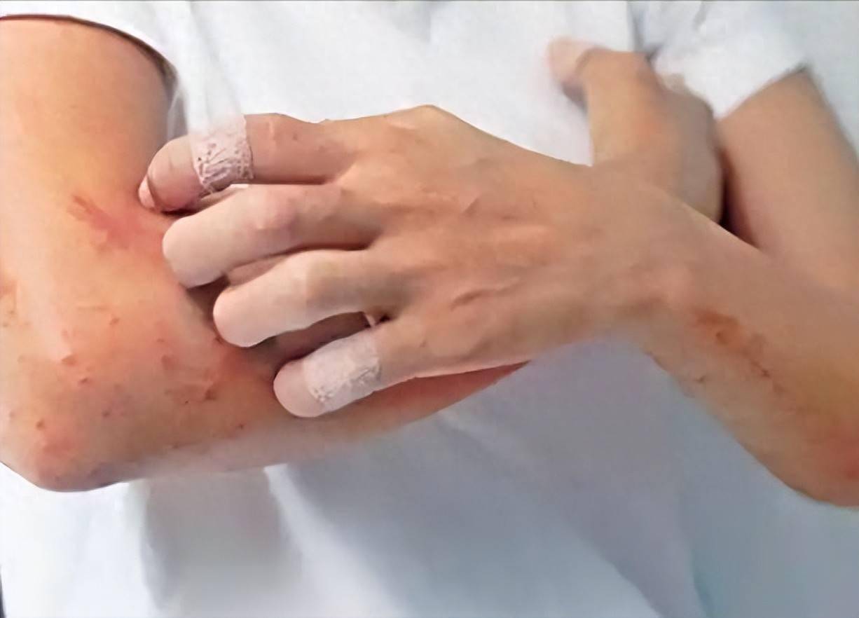 人患银屑病不是无缘无故！医生提醒：得银屑病，离不开这4种因素