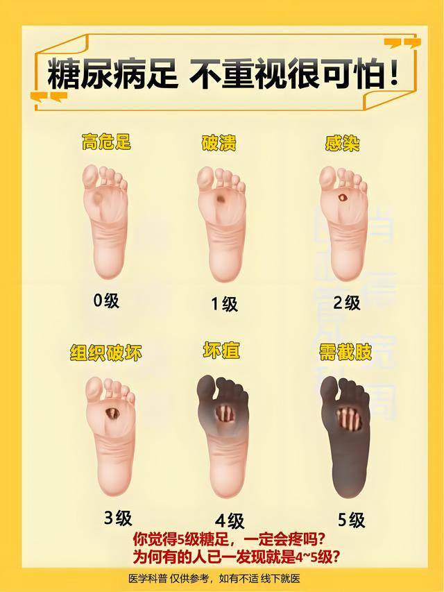 糖尿病大意了！为何不痛不痒脚却突然溃烂？这4招防避免截肢