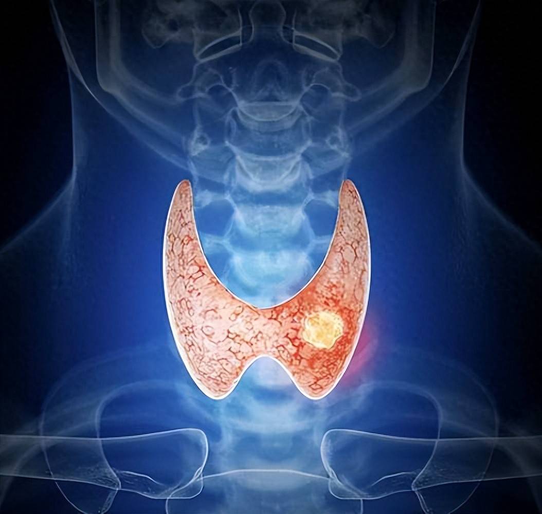 原创            甲状腺癌发病率10年增长4.6倍，早期发现生存率超90%，注意4类症状