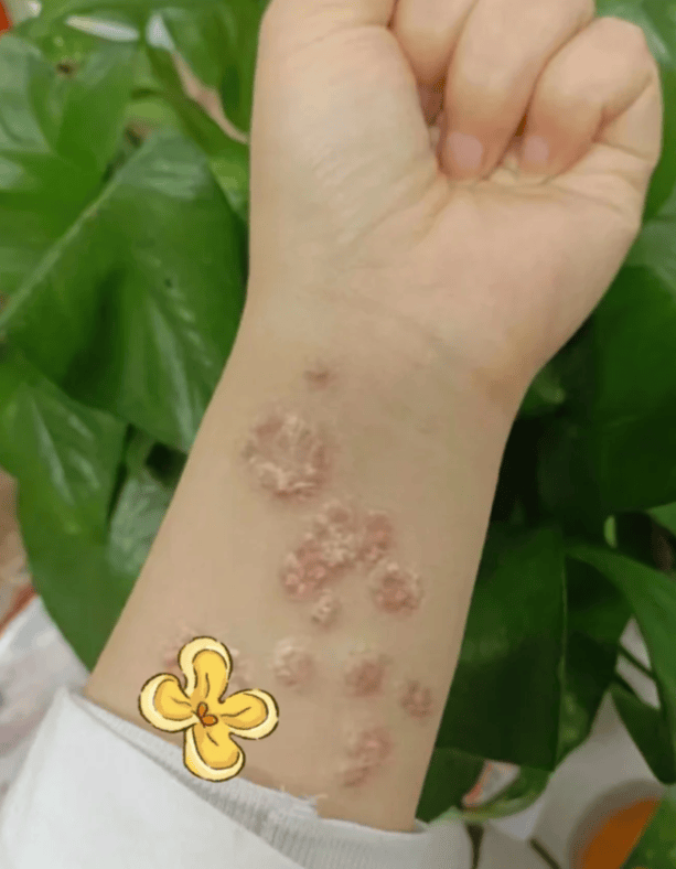印度疗法让牛皮癣患者重获婴儿般光滑肌肤