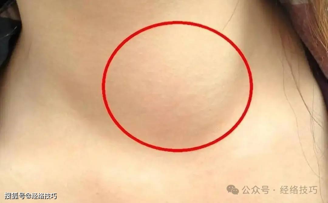 原创            结节形成三阶段，饮食调理有对策