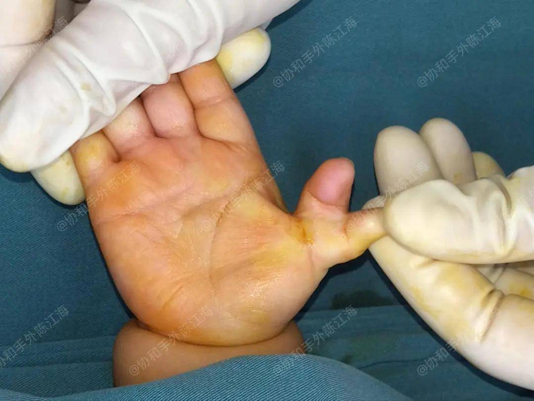 原创            多指│案例30《很庆幸在小的时候做掉了，不然现在肯定很难看》