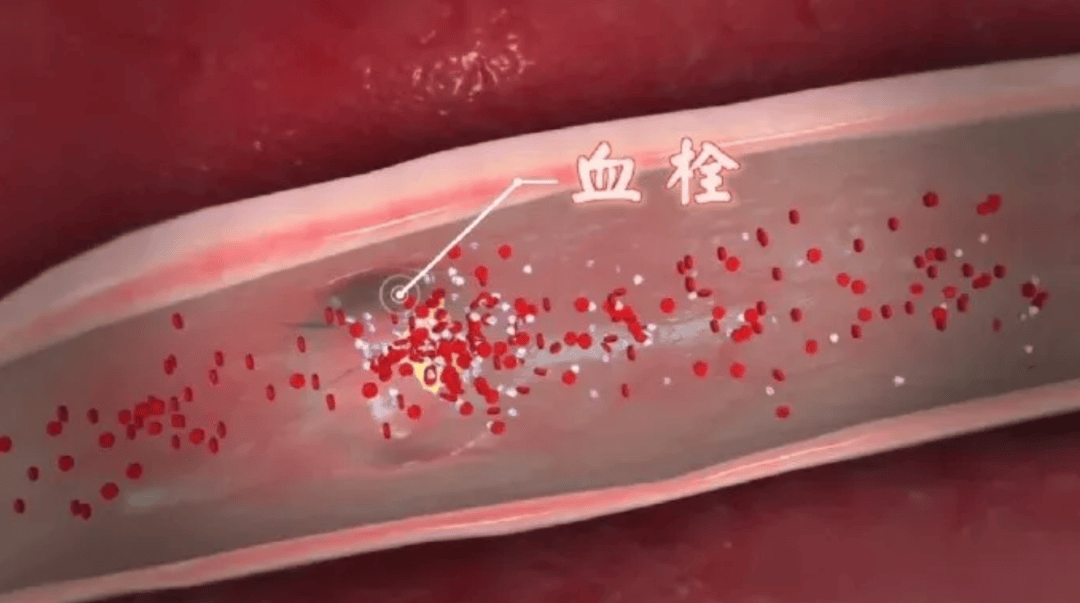 手脚发出这 4 个信号，可能是堵塞前兆！附科学护血管指南