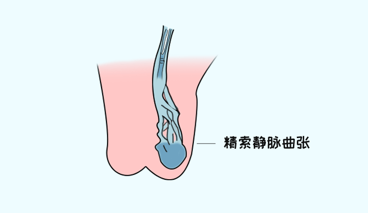 男性精索静脉曲张，对生育有多大影响？