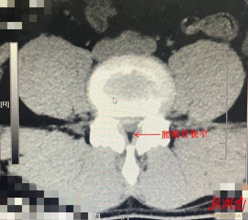 34岁男子腰疼17年！微创手术拯救“老”腰