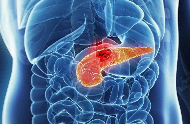 原创            突发腹痛、恶心、呕吐，小心胰腺炎，4类高危人群做好预防