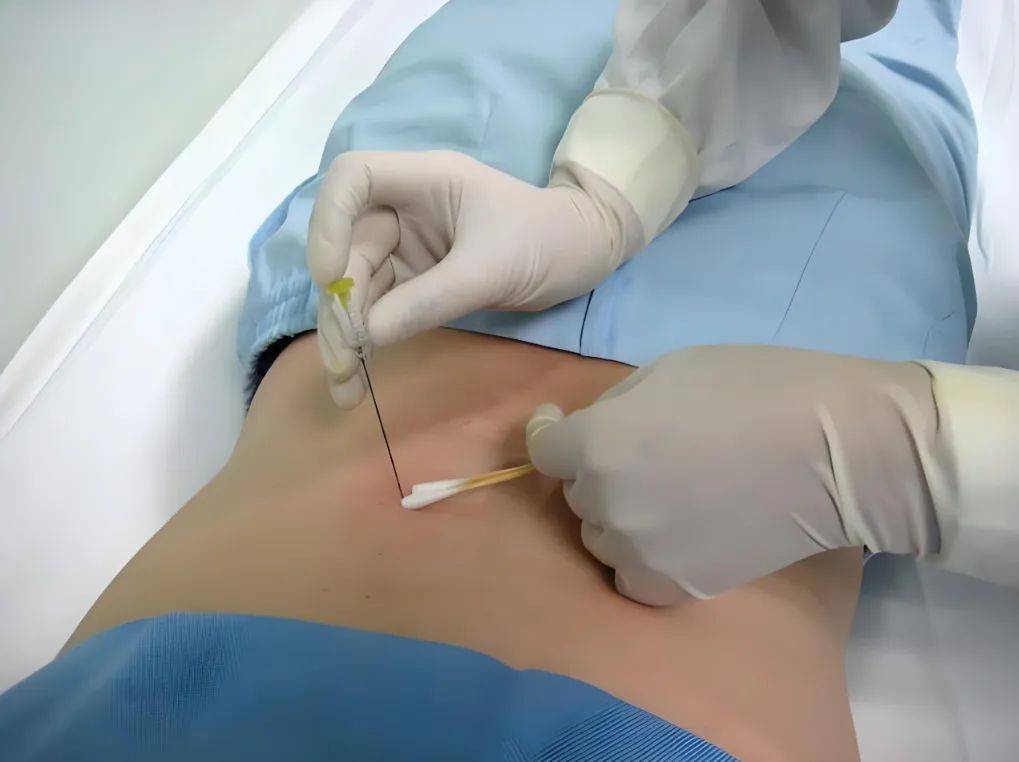 【健康科普】中医药减重：揭秘中医埋线疗法的科学特色