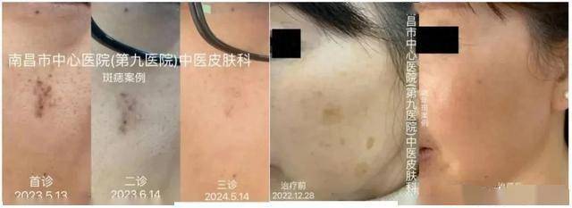 激光美容：解锁肌肤年轻的秘密钥匙