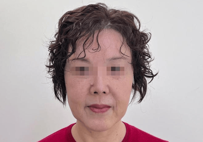 口角提升术，能让你看起来更年轻吗？袁强博士|筋膜提升|拉皮抗衰|面部三件套