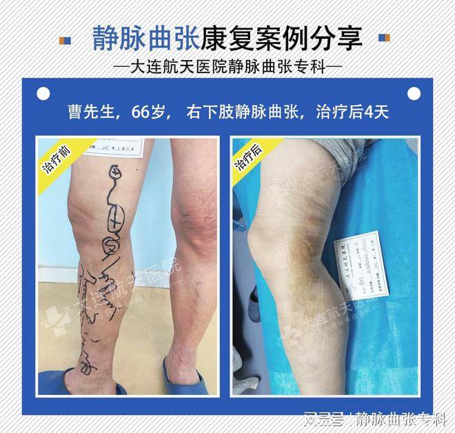 大连航天医院科普|下肢静脉曲张遗传吗？
