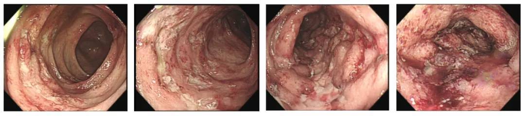 30岁小伙一吃海鲜就便血，查出“绿色癌症”！警惕这些症状