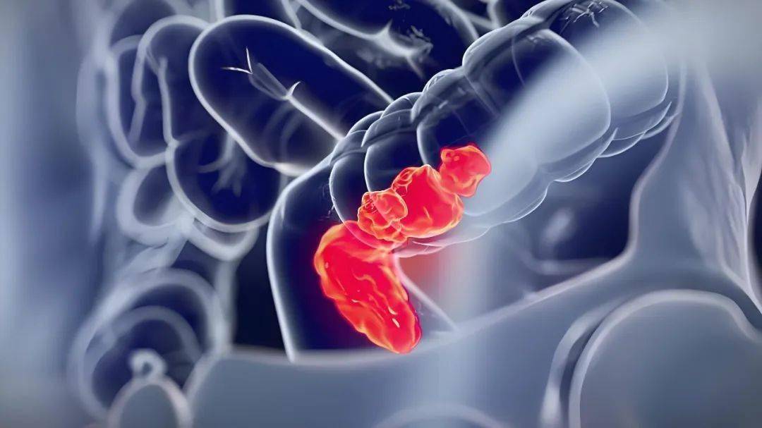 结直肠癌耐药难题迎新解！中国科大发现新分子靶点，或为靶向治疗增效