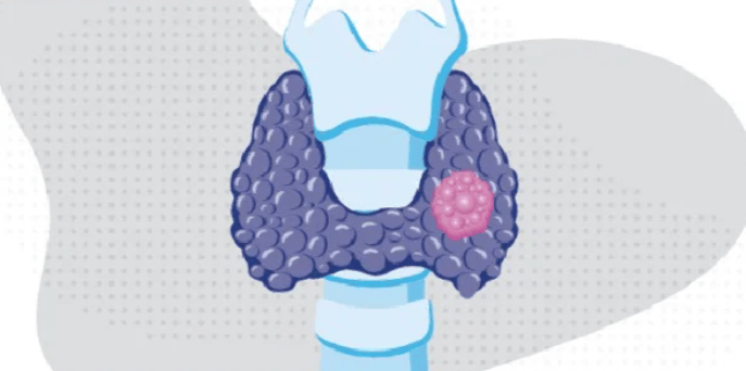 超声发现这些特征，警惕甲状腺癌转移！--南京303甲状腺