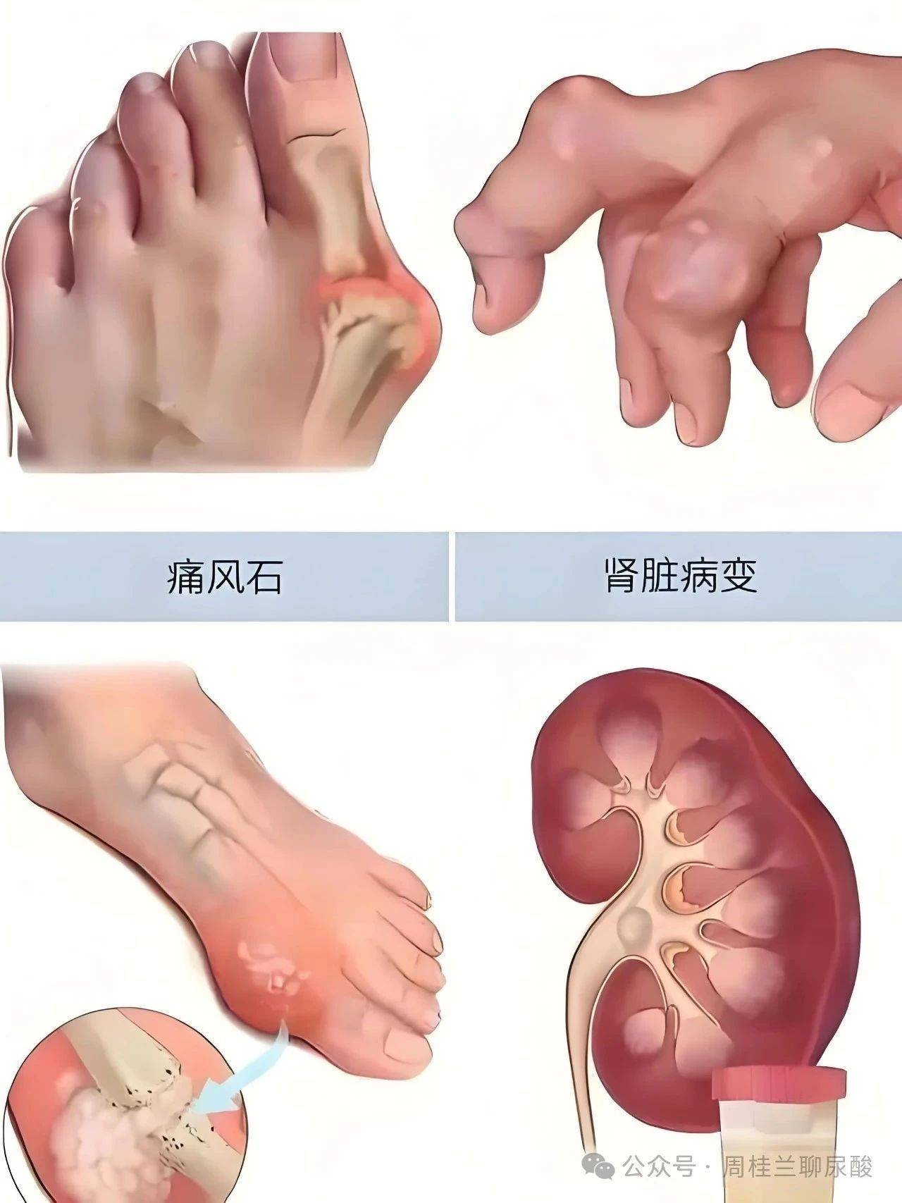 被90%人忽视的细节，尿酸降至320以下！痛风专家周桂兰现场揭秘！