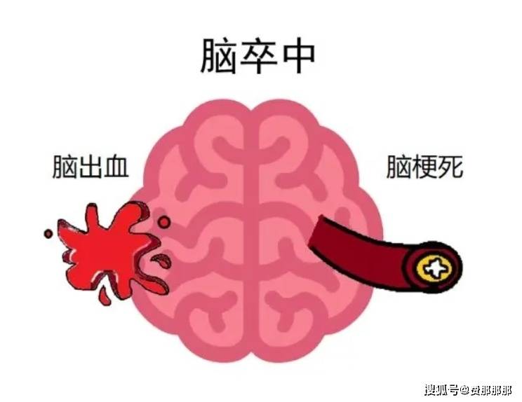 迷雾中的答案：烟雾病能否被彻底治愈？