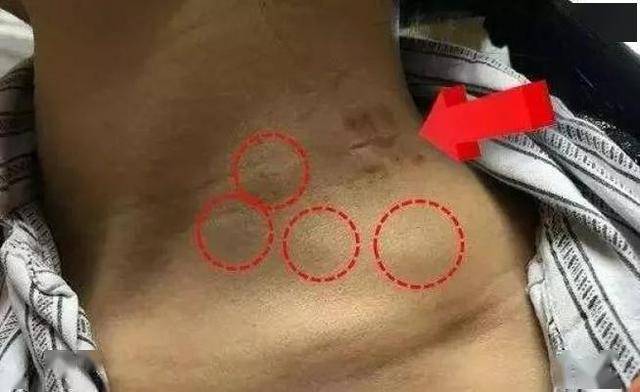 为什么现在淋巴结肿大越来越频繁？医生：这5件事少做，劝你改正