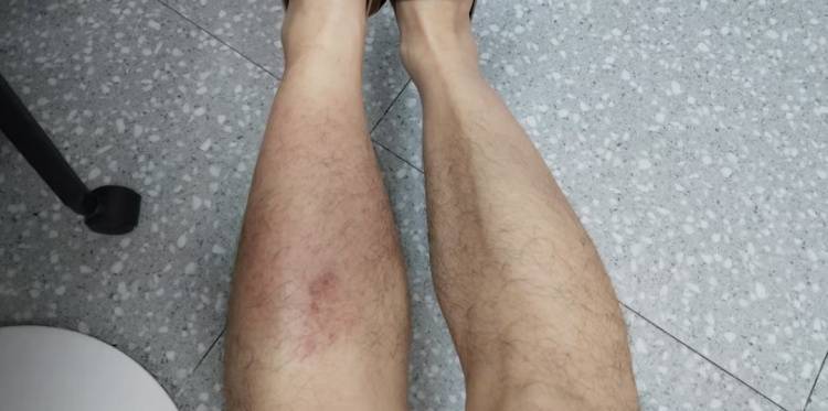 雨天一个动作，男子竟惹“毒”上身！医生：可致败血症