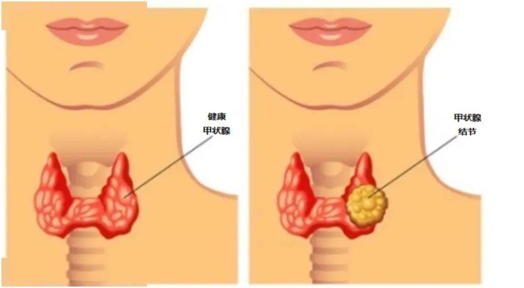 甲状腺结节十问十答