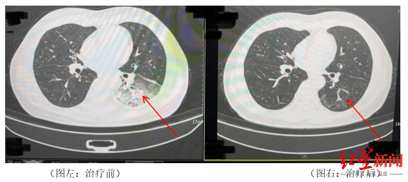 吹了3天空调，男子左肺“白”了一半！专家紧急提醒
