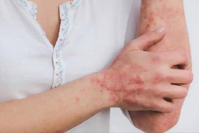 天气炎热，医生叮嘱湿疹患者，宁愿在家躺着，也别轻易去做这4事