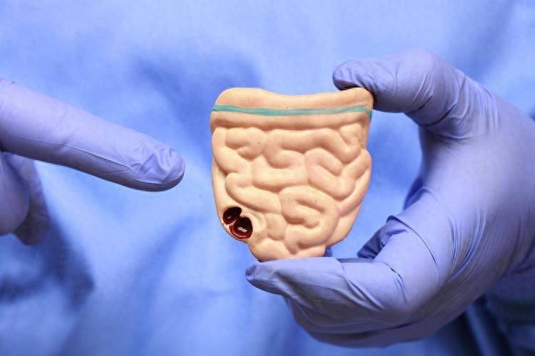 原创            结肠癌早期几乎没有症状，超80%确诊时中晚期，40岁后定期做肠镜