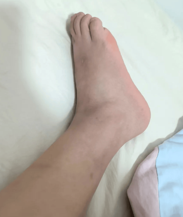 我用这招逆袭牛皮癣，重获光滑肌肤