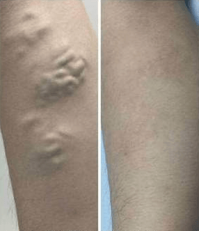 静脉曲张，一颗渐渐逼近引爆的炸弹