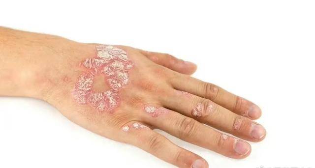 这首经方治疗顽固性银屑病，临床确有实效