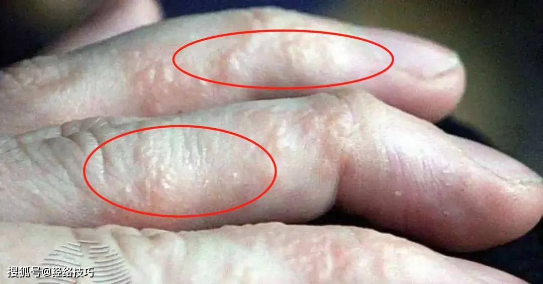 原创            手指小水泡频发？日常养护需注意这些细节