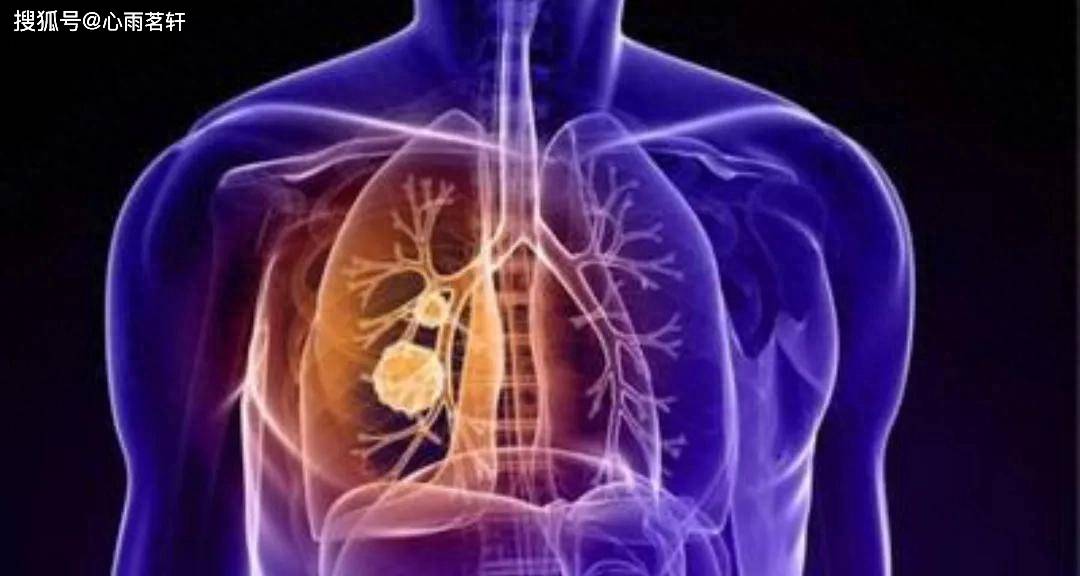 原创            肺癌靶向药：多靶点酪氨酸激酶抑制剂-安罗替尼