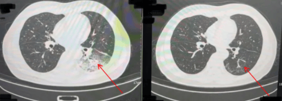 有人直接“白肺”！高发期海盐人注意！