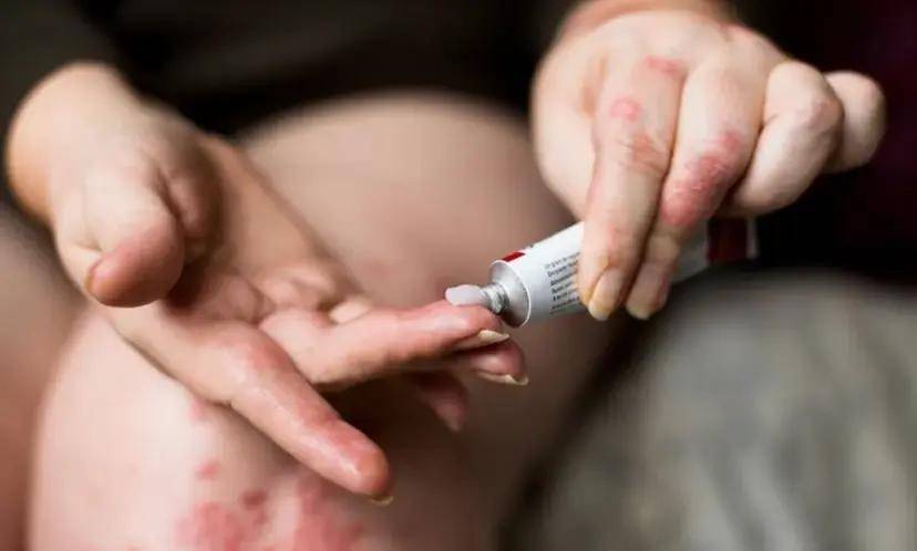 银屑病认知误区十条，知道这些可更好的防治！