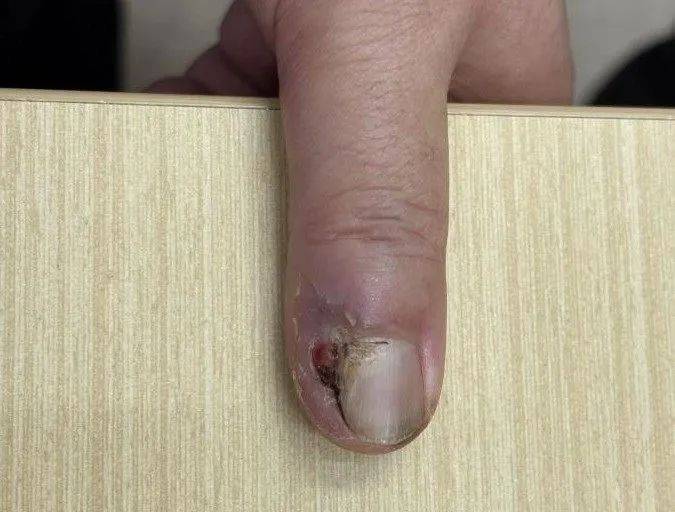 指甲有问题不要忽视，可能是癌症！