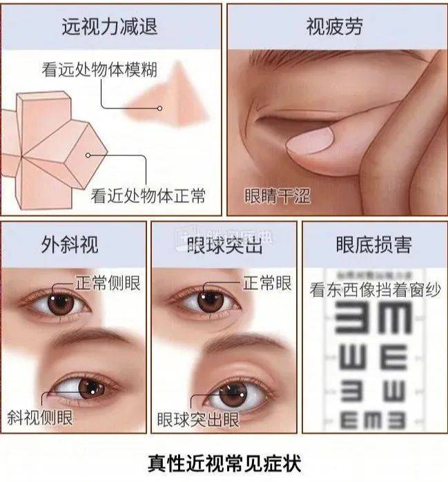 要开学了，娃近视多少度需要戴眼镜？